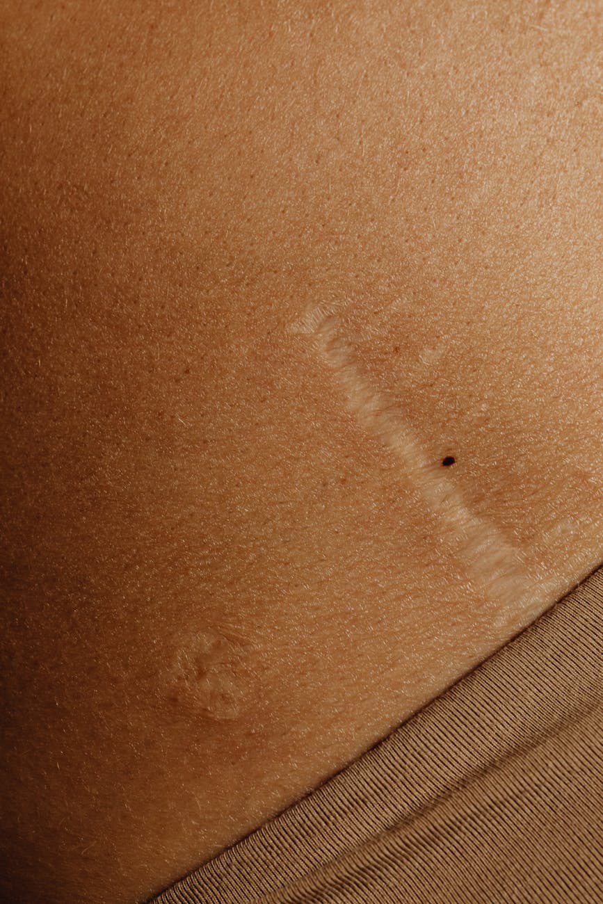 gros plan d'un corps avec une cicatrice (massage et cicatrices)